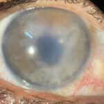 Pseudophakic Bullous Keratopathy