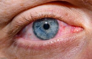 Sjögren’s Syndrome