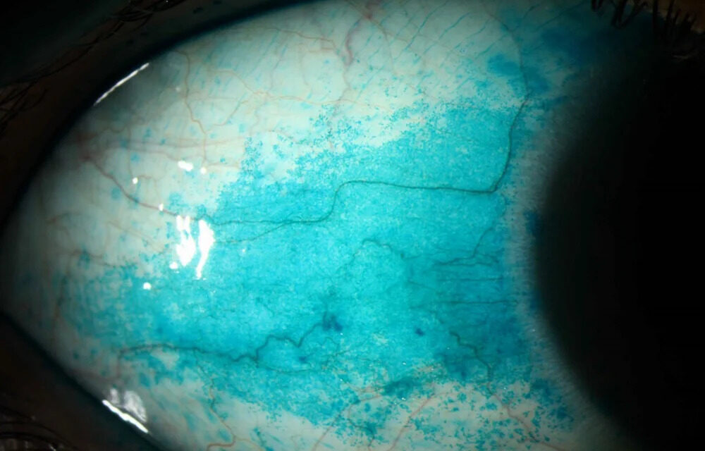 Sjögren’s Syndrome: Ocular Manifestations and Clinical Management