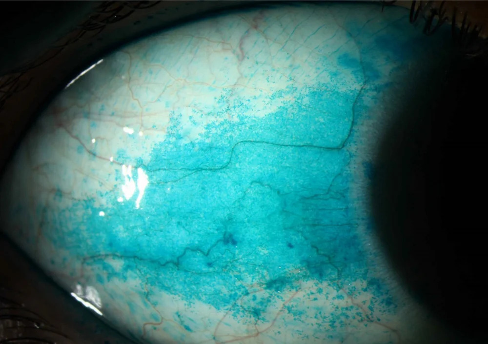 Sjögren’s Syndrome