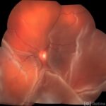 Bullous Retinal Detachment