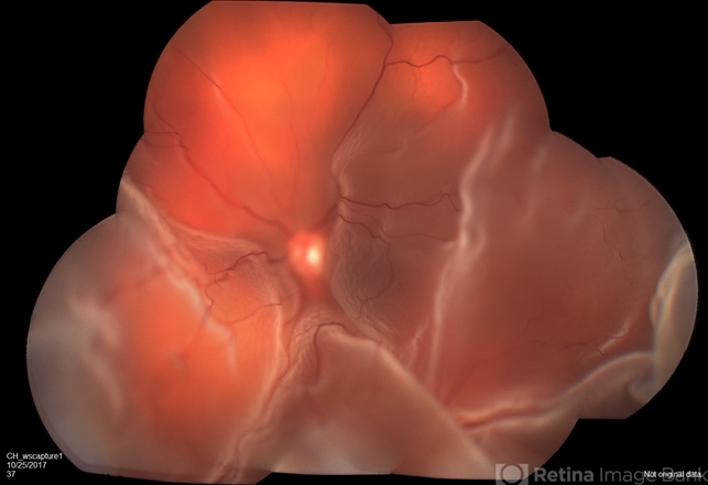 Bullous Retinal Detachment