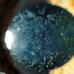 Corneal Stromal Dystrophy