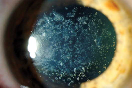 Corneal Stromal Dystrophy: Clinical Features, Diagnosis, and Management