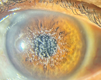 Corneal Stromal Dystrophy
