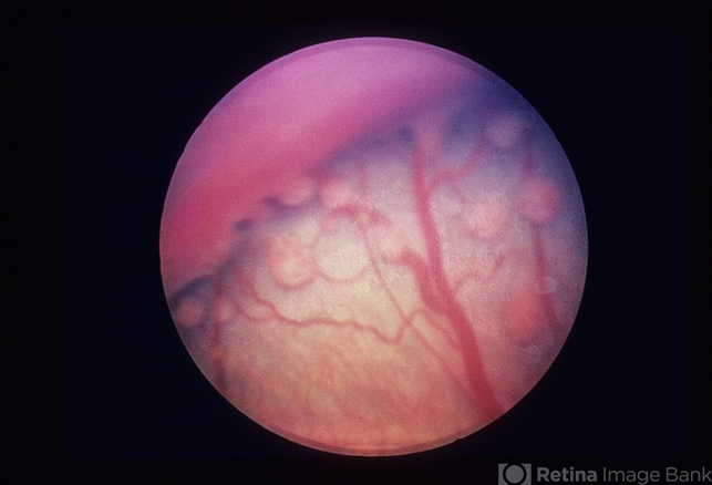 Retrolental Fibroplasia