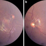 Septo-optic Dysplasia