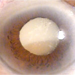 Phacolytic Glaucoma