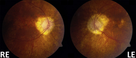 Chronic Progressive External Ophthalmoplegia (CPEO)