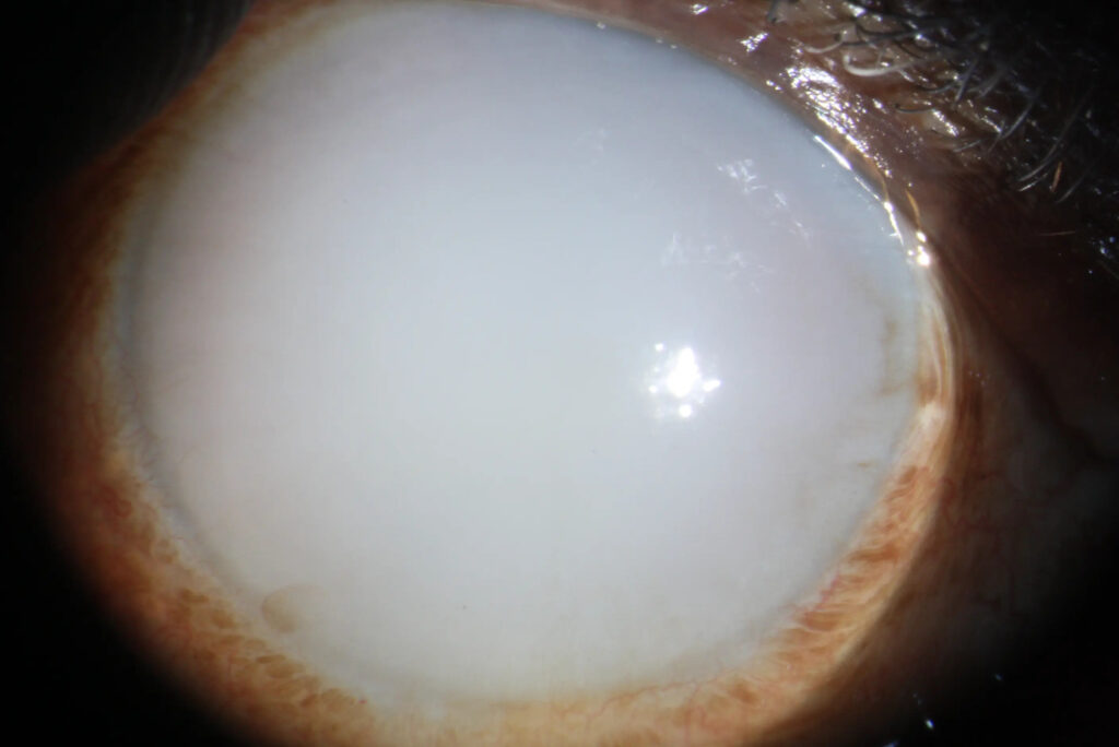 Phacolytic Glaucoma
