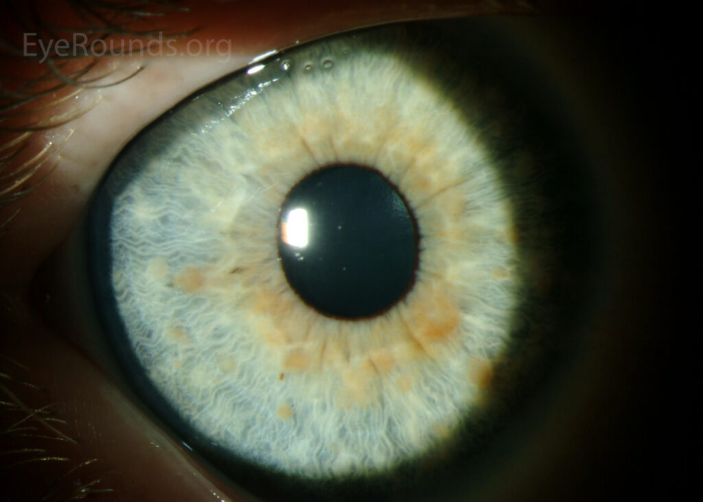 Iris Hamartomas