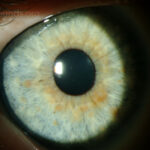 Iris Hamartomas