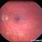 Chronic Progressive External Ophthalmoplegia (CPEO)