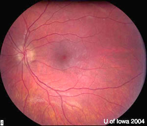 Chronic Progressive External Ophthalmoplegia (CPEO)