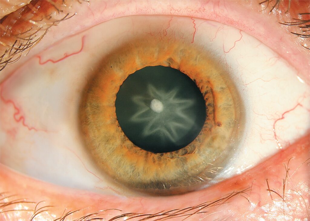 Rosette-Shaped Cataract