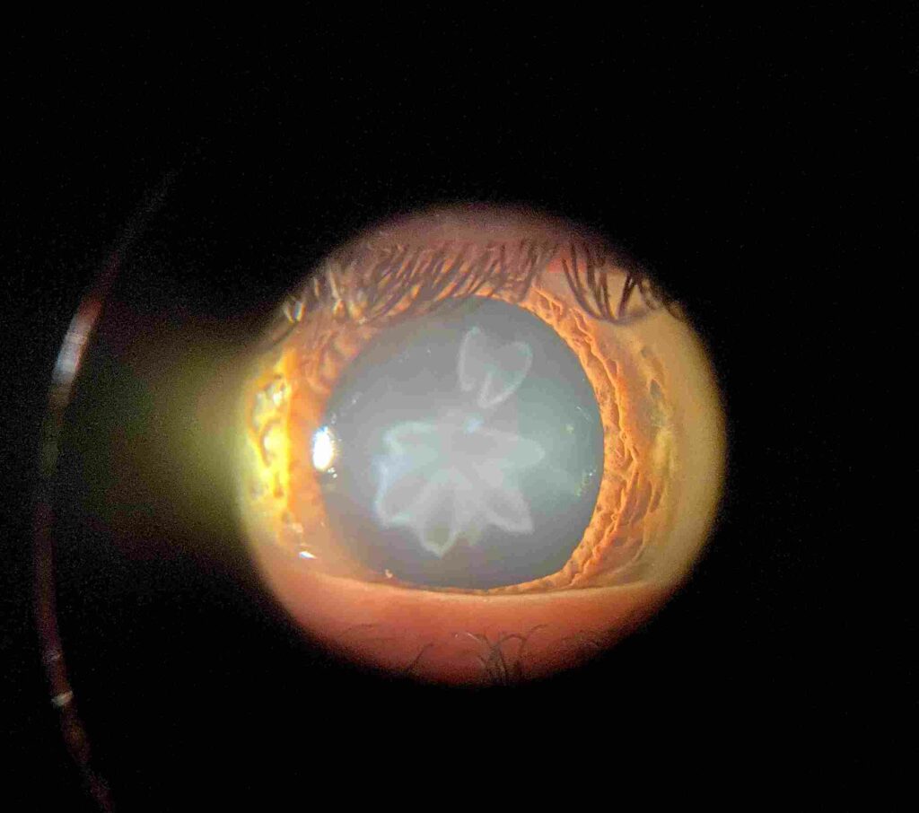 Rosette-Shaped Cataract