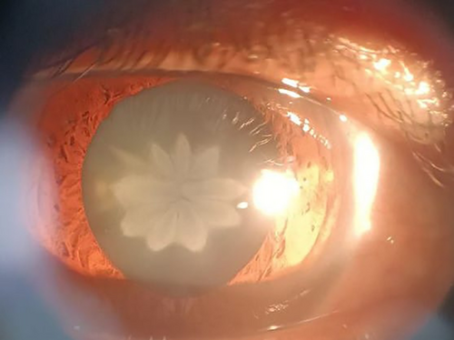 Rosette-Shaped Cataract