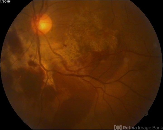 Retinitis Sclopetaria