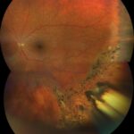 Retinitis Sclopetaria