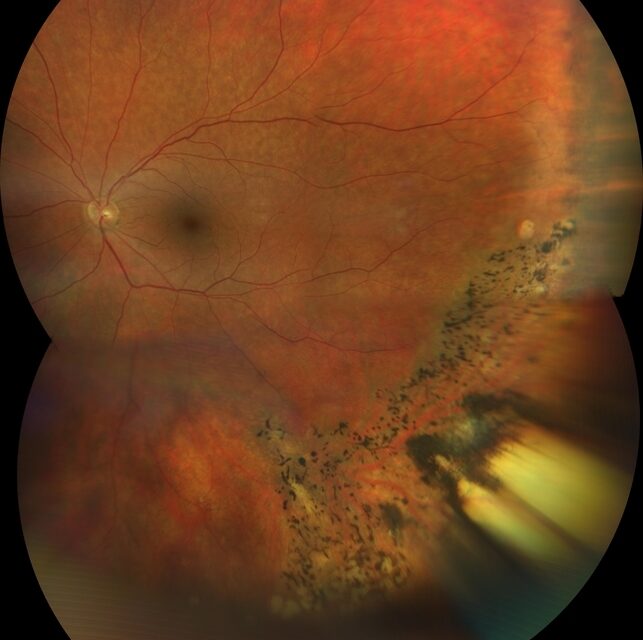 Retinitis Sclopetaria