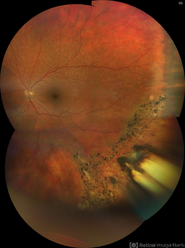 Retinitis Sclopetaria