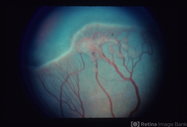 Retrolental Fibroplasia