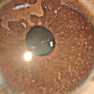 Iris Hamartomas