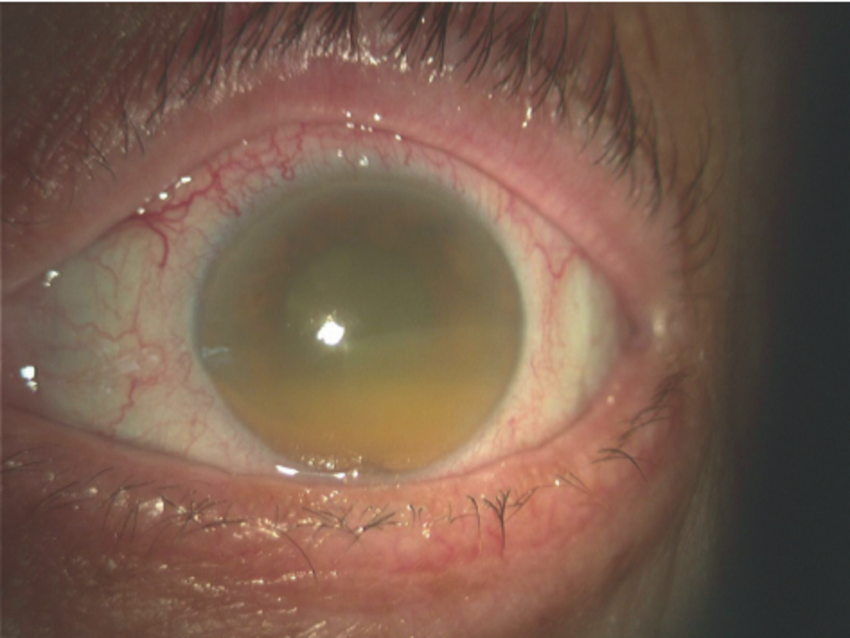 Phacolytic Glaucoma