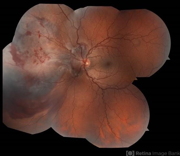Retinitis Sclopetaria