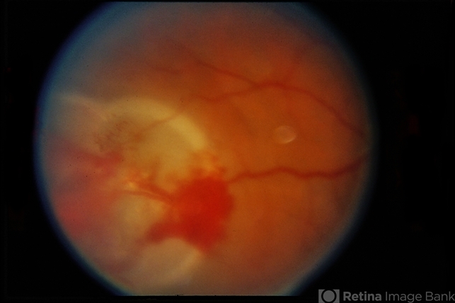 Retinal Capillary Hemangioblastoma