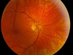 Autoimmune Retinopathy