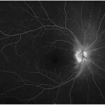 Acute Idiopathic Blind Spot Enlargement Syndrome