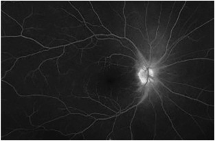 Acute Idiopathic Blind Spot Enlargement Syndrome: A full study
