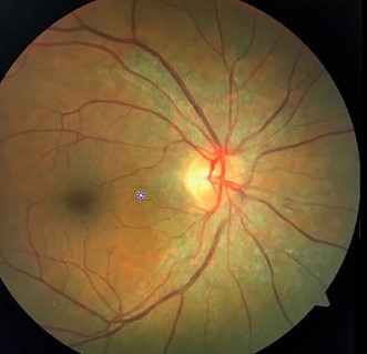 Acute Idiopathic Blind Spot Enlargement Syndrome