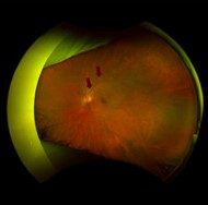 Acute Idiopathic Blind Spot Enlargement Syndrome