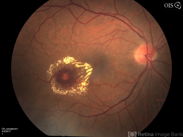 Retinal Capillary Hemangioblastoma