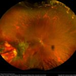 Retinitis Sclopetaria
