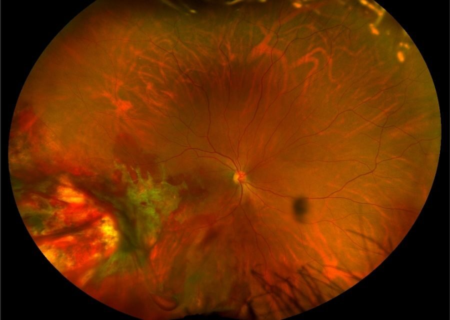 Retinitis Sclopetaria: Traumatic Retinal Injury Without Rupture
