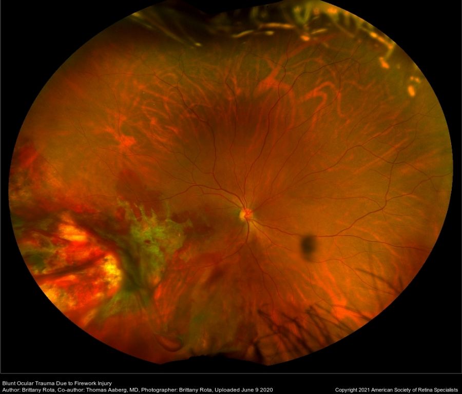Retinitis Sclopetaria