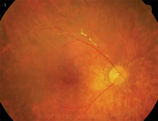 Autoimmune Retinopathy