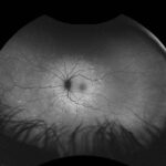 Multiple Evanescent White Dot Syndrome
