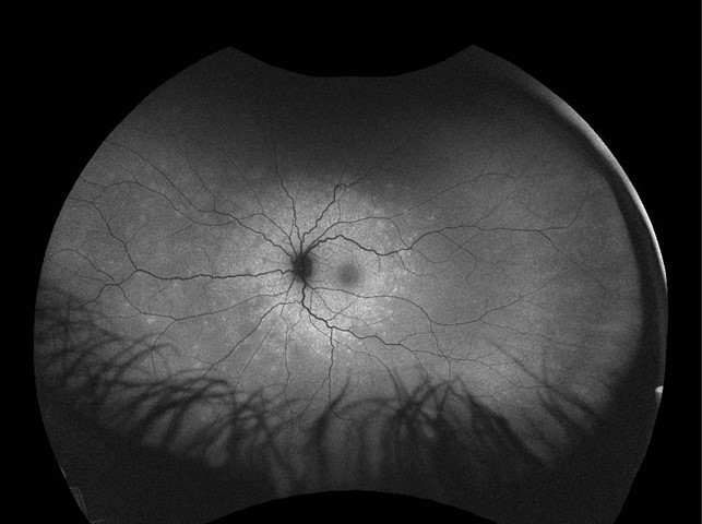 Multiple Evanescent White Dot Syndrome: All you need to know!