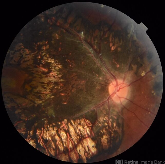 Pigmented Paravenous Retinochoroidal Atrophy: A Rare Retinal Disorder