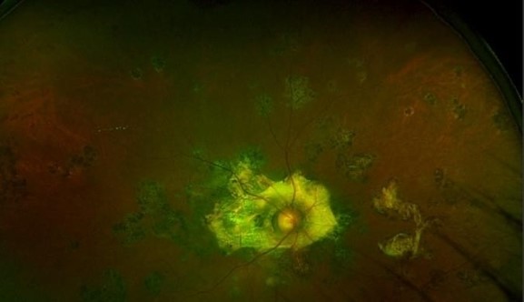 Multiple Evanescent White Dot Syndrome
