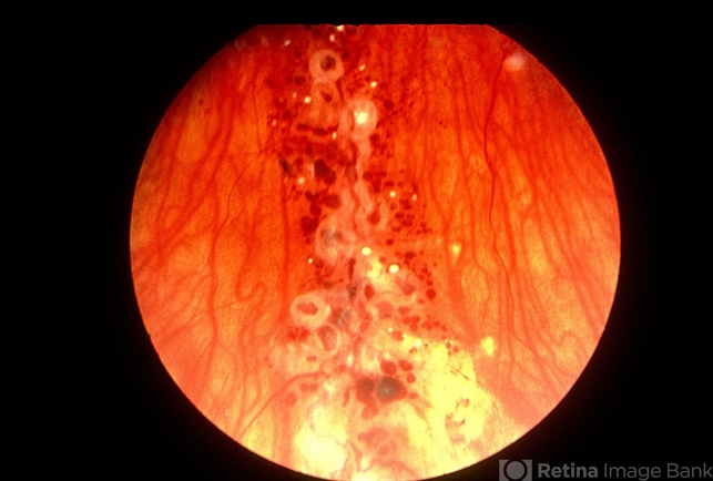 Retinal Cavernous Hemangioma