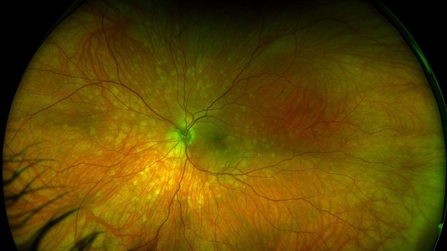 Multiple Evanescent White Dot Syndrome
