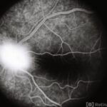 Retinal Capillary Hemangioblastoma