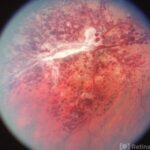 Retinal Cavernous Hemangioma
