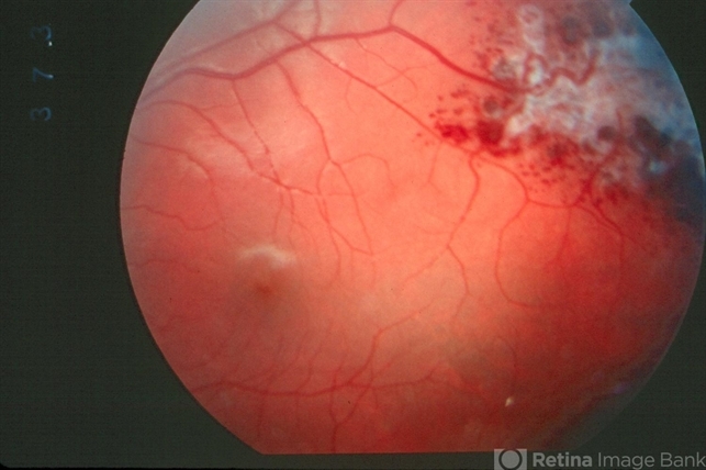 Retinal Cavernous Hemangioma