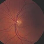 Autoimmune Retinopathy